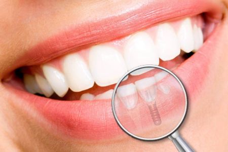 IMPLANTOLOGÍA ORAL